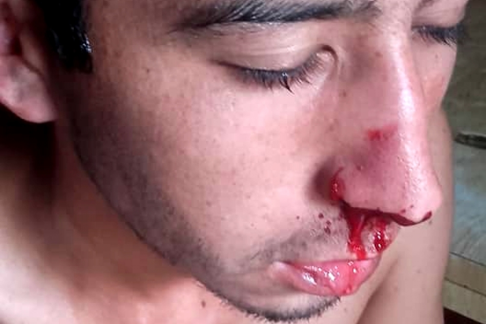 Axel recibi&oacute; un mazazo en la nariz.